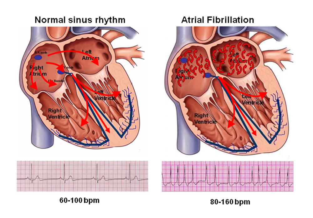 Aortic Aneurysm