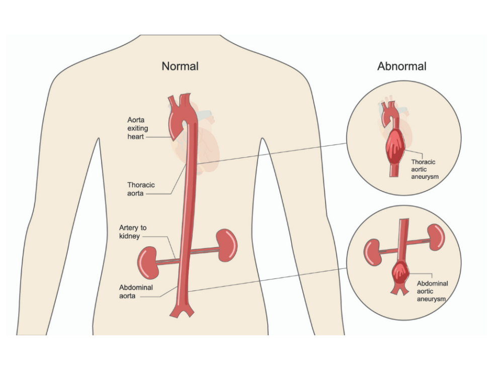 Aortic Aneurysm