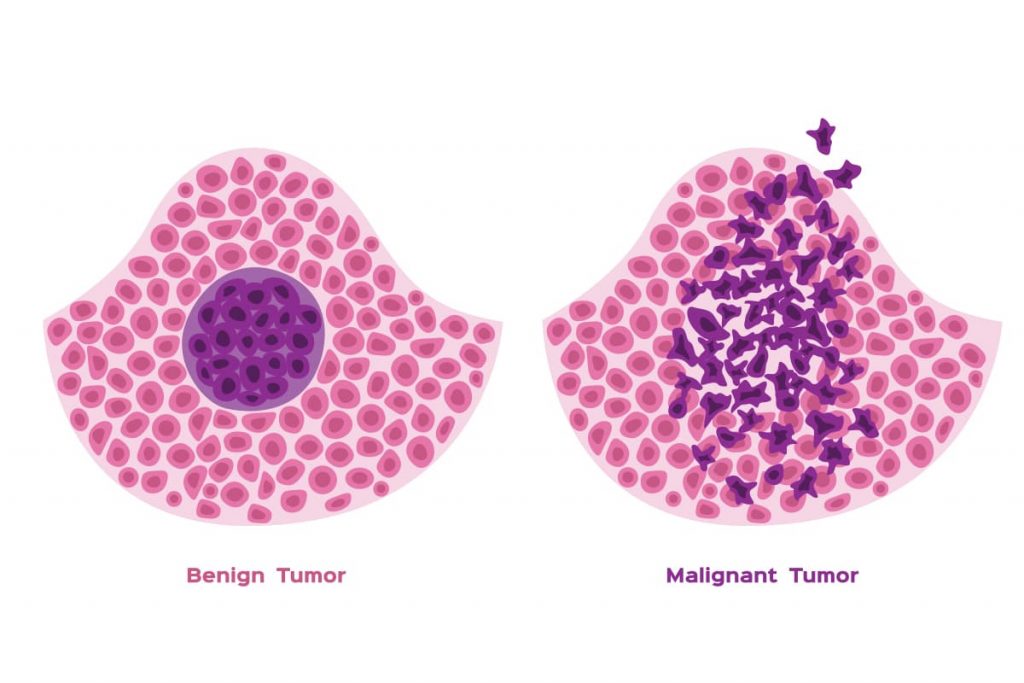 Malignant Tumor