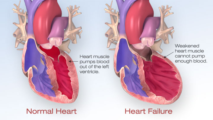 Aortic Aneurysm