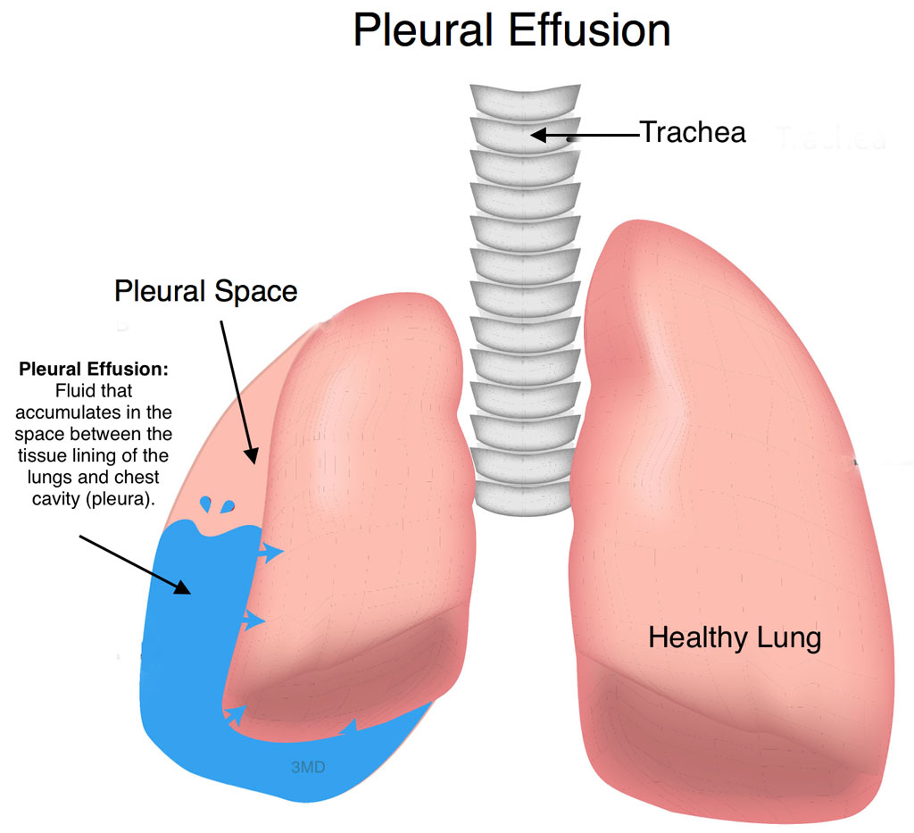 Pleural Effusion